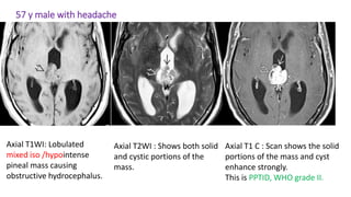 57 y male with headache
Axial T1WI: Lobulated
mixed iso /hypointense
pineal mass causing
obstructive hydrocephalus.
Axial T2WI : Shows both solid
and cystic portions of the
mass.
Axial T1 C : Scan shows the solid
portions of the mass and cyst
enhance strongly.
This is PPTID, WHO grade II.
 