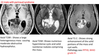 22 male with parinaud syndrome
Axial T1WI : Shows a large
heterogeneous mass causing
moderate obstructive
hydrocephalus.
Axial T2WI :Shows numerous
hyperintense cysts and solid
isointense nodules comprising
the mass.
Axial T1 C : Shows strong
enhancement of the solid
portions of the mass and
cyst walls.
Pathology was PPTID, WHO
grade III.
 