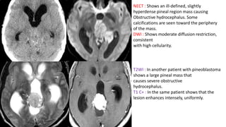 NECT : Shows an ill-defined, slightly
hyperdense pineal region mass causing
Obstructive hydrocephalus. Some
calcifications are seen toward the periphery
of the mass.
DWI : Shows moderate diffusion restriction,
consistent
with high cellularity.
T2WI : In another patient with pineoblastoma
shows a large pineal mass that
causes severe obstructive
hydrocephalus.
T1 C+ : In the same patient shows that the
lesion enhances intensely, uniformly.
 
