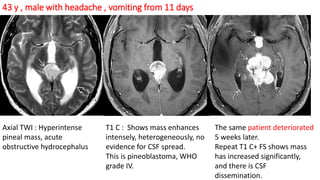 43 y , male with headache , vomiting from 11 days
Axial TWI : Hyperintense
pineal mass, acute
obstructive hydrocephalus
T1 C : Shows mass enhances
intensely, heterogeneously, no
evidence for CSF spread.
This is pineoblastoma, WHO
grade IV.
The same patient deteriorated
5 weeks later.
Repeat T1 C+ FS shows mass
has increased significantly,
and there is CSF
dissemination.
 