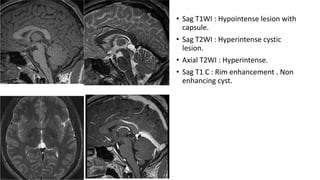• Sag T1WI : Hypointense lesion with
capsule.
• Sag T2WI : Hyperintense cystic
lesion.
• Axial T2WI : Hyperintense.
• Sag T1 C : Rim enhancement . Non
enhancing cyst.
 
