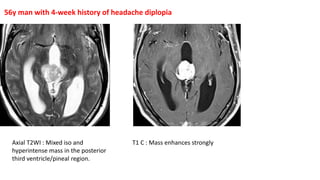 56y man with 4-week history of headache diplopia
Axial T2WI : Mixed iso and
hyperintense mass in the posterior
third ventricle/pineal region.
T1 C : Mass enhances strongly
 