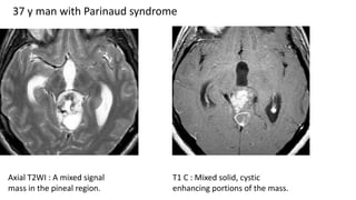 37 y man with Parinaud syndrome
Axial T2WI : A mixed signal
mass in the pineal region.
T1 C : Mixed solid, cystic
enhancing portions of the mass.
 