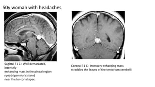 50y woman with headaches
Sagittal T1 C : Well demarcated,
intensely
enhancing mass in the pineal region
(quadrigeminal cistern)
near the tentorial apex.
Coronal T1 C : Intensely enhancing mass
straddles the leaves of the tentorium cerebelli
 
