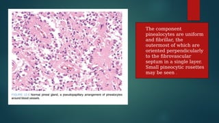 pineal gland tumors ( pineal gland )- approach | PPTX