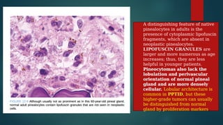 pineal gland tumors ( pineal gland )- approach | PPTX