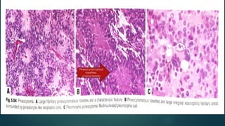 pineal gland tumors ( pineal gland )- approach | PPTX