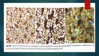 pineal gland tumors ( pineal gland )- approach | PPTX