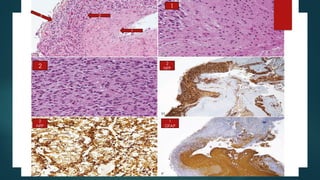 pineal gland tumors ( pineal gland )- approach | PPTX