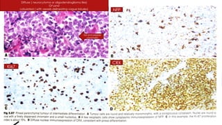 pineal gland tumors ( pineal gland )- approach | PPTX