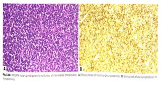 pineal gland tumors ( pineal gland )- approach | PPTX