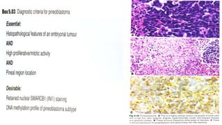 pineal gland tumors ( pineal gland )- approach | PPTX