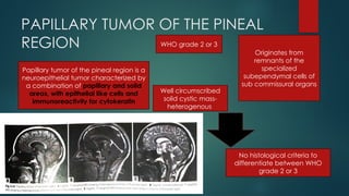 pineal gland tumors ( pineal gland )- approach | PPTX