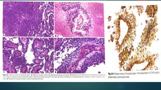pineal gland tumors ( pineal gland )- approach | PPTX