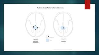 pineal gland tumors ( pineal gland )- approach | PPTX