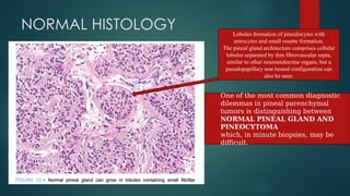 pineal gland tumors ( pineal gland )- approach | PPTX