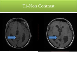 T1-Non Contrast
 