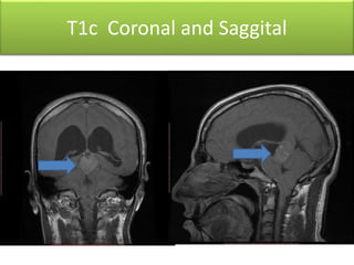 T1c Coronal and Saggital
 