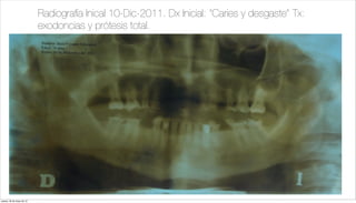 Radiografía Inical 10-Dic-2011. Dx Inicial: “Caries y desgaste” Tx:
exodoncias y prótesis total.
jueves, 30 de mayo de 13
 
