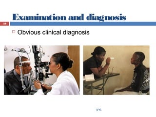 Examination and diagnosis
 Obvious clinical diagnosis
IPS
19
 