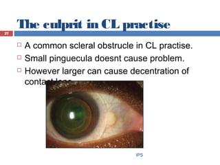The culprit in CL practise
 A common scleral obstrucle in CL practise.
 Small pinguecula doesnt cause problem.
 However...