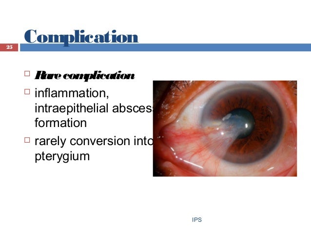 Pinguecula - An overview Pinguecula - An overview
