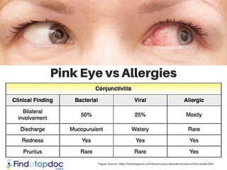 Pink Eye vs Allergies
Figure Source: https://smartypance.com/lessons/eye-disorders/conjunctivitis-reeldx100/
 