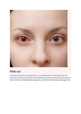 Pink eye
Pink eye, also known as conjunctivitis, is an inflammation of the conjunctiva, the
clear tissue that lines the inside of the eyelid and covers the white part of the eye.For
more visit https://heathylife4you.blogspot.com/2023/07/pink-eyes-vs-allergies.html
 