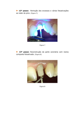 ► 12º passo: Remoção dos excessos e várias fotoativações
ao redor do pino. (Figura 7)
Figura 7
► 13º passo: Reconstrução da parte coronária com resina
composta fotoativada. (Figura 8)
Figura 8
 