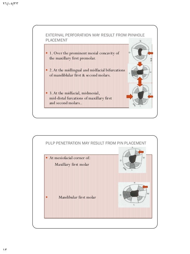 Pin retained amalgam restorations