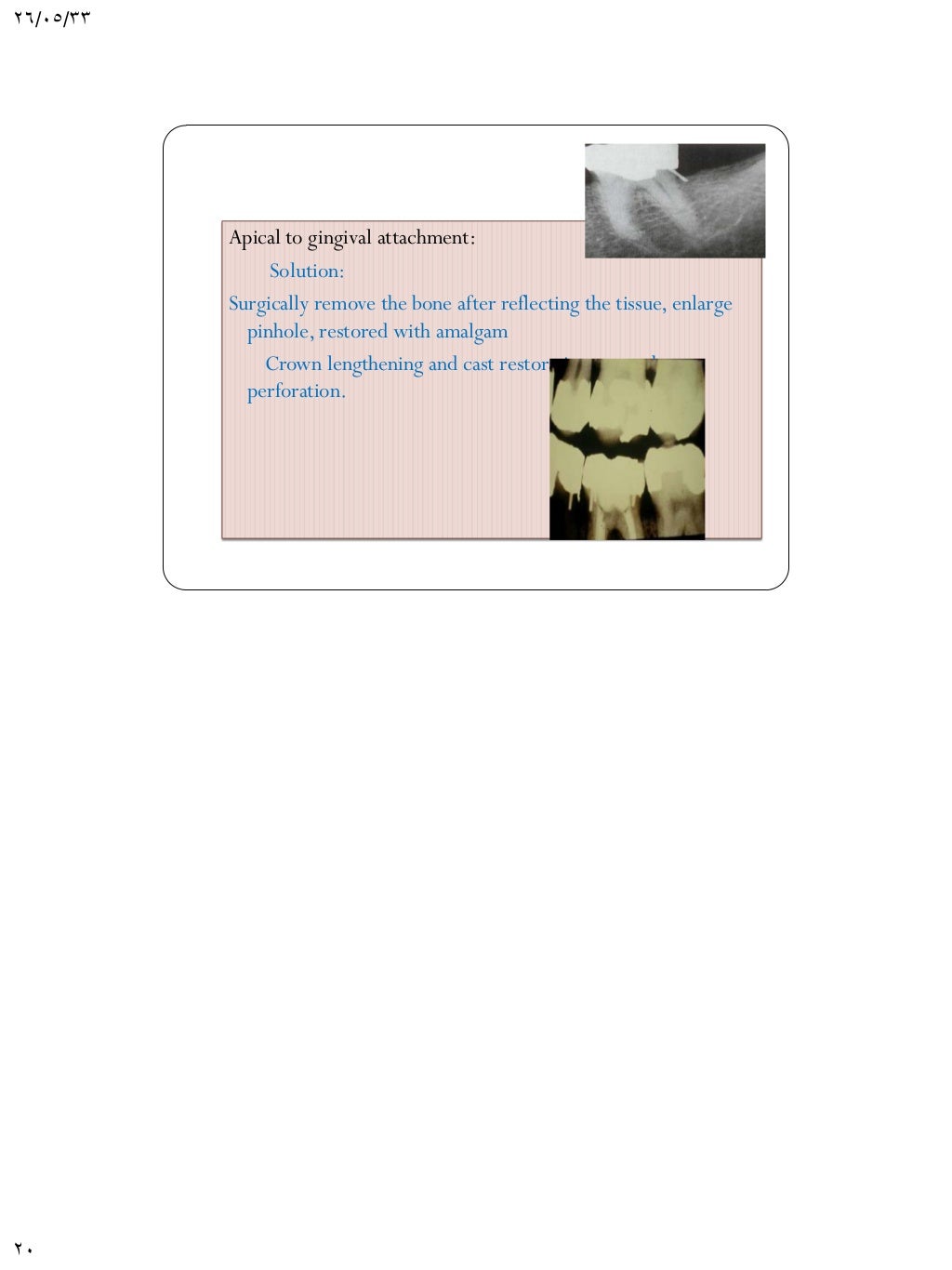 Pin retained amalgam restorations