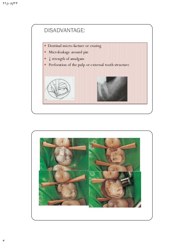 Pin retained amalgam restorations