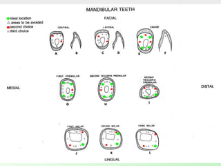 Pin Retaing Feature Pin retained restorations | PPTX