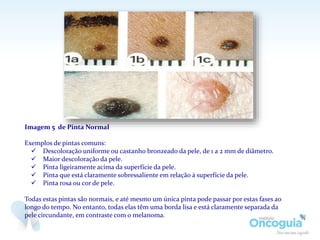 Pintas Instrumento Pintas x Melanoma: Saiba Diferenciar | PPTX