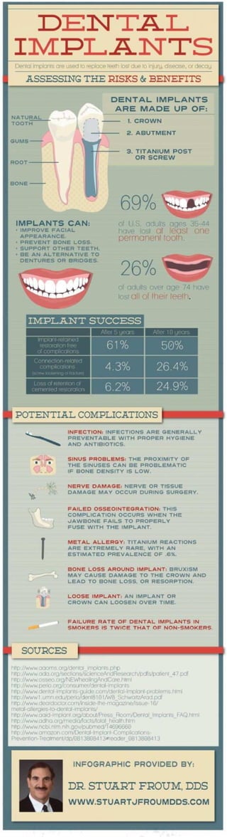 facts on implants 