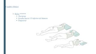 Cuadro clínico
 Dolor ******
 Nocturno
 Irradia hacia 1/3 inferior de húmero
 Empeorar
 