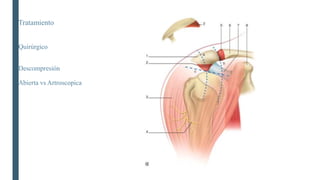 Tratamiento
Quirúrgico
Descompresión
Abierta vs Artroscopica
 