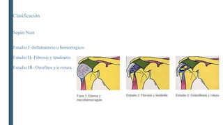 Clasificación
Según Neer
Estadio I -Inflamatorio o hemorragico-
Estadio II- Fibrosis y tendinitis
Estadio III- Ostofitos y/o rotura
 