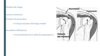 Factores de riesgo
Factores extrínsecos
Primarios (Estructurales)
 Choque mecánico del mango rotador
Secundarios (Dinámicos)
 Estrechamiento de la salida del supraespinoso
 