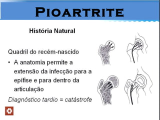Pioartrite 