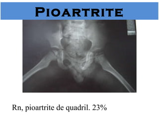 Rn, pioartrite de quadril. 23% Pioartrite 