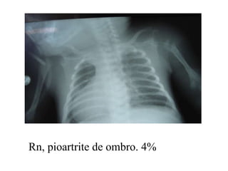 Rn, pioartrite de ombro. 4% 