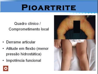 Pioartrite 