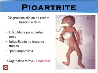 Pioartrite 