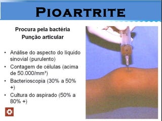 Pioartrite 