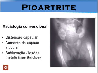 Pioartrite 