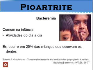 Pioartrite 