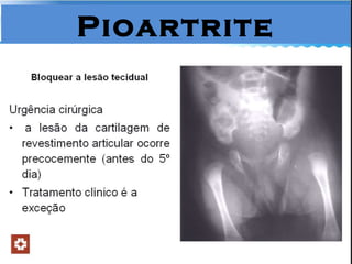 Pioartrite 