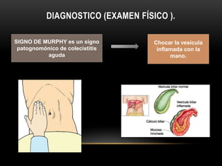 DIAGNOSTICO (EXAMEN FÍSICO ).

SIGNO DE MURPHY es un signo        Chocar la vesícula
 patognomónico de colecistitis      inflamada con la
          aguda                          mano.
 