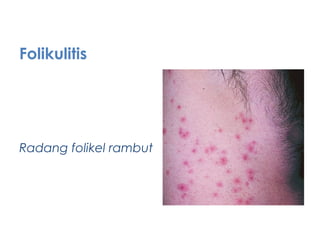 Folikulitis
Radang folikel rambut
